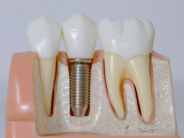Dental Implant | Smile Doctors Dental Center